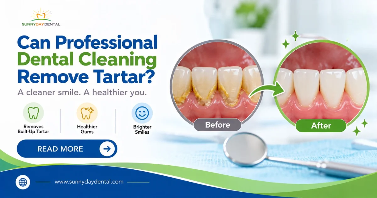 Can Professional Dental Cleaning Remove Tartar